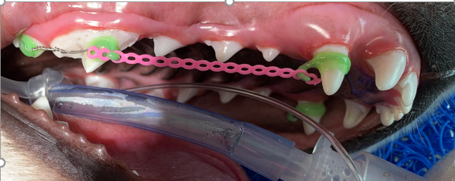 
Correction of the position of the upper canine tooth using braces